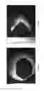 Fig. 06 - Systems and methods for eccentric nodule tissue acquisition