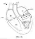 Fig. 33 - Multi-window guide tunnel