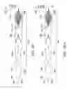 Fig. 112 - Clot retrieval system