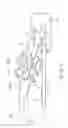 Fig. 08 - FORCEPS-TYPE TREATMENT INSTRUMENT