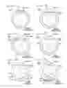 Fig. 07 - Medical puncture needle and method for manufacturing puncture needle