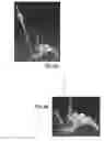 Fig. 08 - Spondylisthesis reduction system