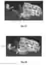 Fig. 10 - Spondylisthesis reduction system