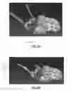 Fig. 13 - Spondylisthesis reduction system