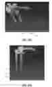 Fig. 17 - Spondylisthesis reduction system
