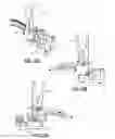 Fig. 30 - Spondylisthesis reduction system