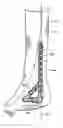 Fig. 01 - Ankle tibia plates