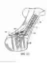 Fig. 04 - Ankle tibia plates