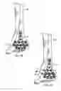 Fig. 06 - Ankle tibia plates