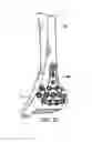 Fig. 07 - Ankle tibia plates