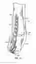 Fig. 09 - Ankle tibia plates