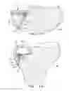 Fig. 06 - Orthopaedic implant with fixation feature and a method of implanting thereof