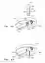 Fig. 10 - Orthopaedic implant with fixation feature and a method of implanting thereof