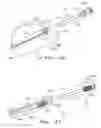 Fig. 12 - Orthopaedic implant with fixation feature and a method of implanting thereof