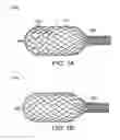Fig. 02 - Delivery of apparatus and methods for vertebrostening