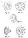 Fig. 02 - Implant device and system for ablation of a vessel's wall from the inside