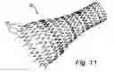 Fig. 09 - Implant device and system for ablation of a vessel's wall from the inside