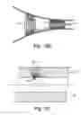Fig. 20 - Implant device and system for ablation of a vessel's wall from the inside