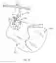 Fig. 35 - Systems and methods for patient-based computer assisted surgical procedures