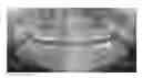 Fig. 01 - Therapeutic tooth bud ablation