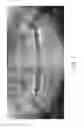 Fig. 02 - Therapeutic tooth bud ablation