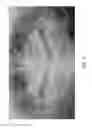 Fig. 03 - Therapeutic tooth bud ablation