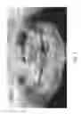 Fig. 04 - Therapeutic tooth bud ablation