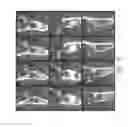 Fig. 16 - Therapeutic tooth bud ablation