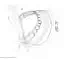 Fig. 30 - Therapeutic tooth bud ablation