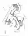 Fig. 02 - Mandibular reposition device and coupling therefor
