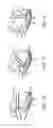 Fig. 09 - Method for providing support to a urethra in treating urinary incontinence