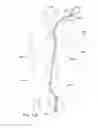 Fig. 17 - Endoluminal prosthesis having multiple branches or fenestrations and methods of deployment