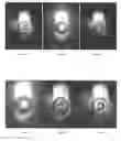 Fig. 05 - IOL WITH REDUCED PUPILLARY REFLECTIONS