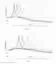 Fig. 06 - IOL WITH REDUCED PUPILLARY REFLECTIONS