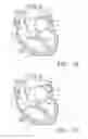 Fig. 02 - Prosthetic Tissue Valves