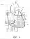 Fig. 07 - Prosthetic Tissue Valves