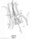 Fig. 02 - Devices, systems and methods to improve placement and prevent heart block with percutaneous aortic valve replacement