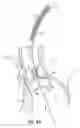 Fig. 08 - Devices, systems and methods to improve placement and prevent heart block with percutaneous aortic valve replacement