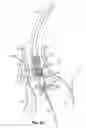 Fig. 22 - Devices, systems and methods to improve placement and prevent heart block with percutaneous aortic valve replacement