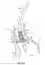 Fig. 33 - Devices, systems and methods to improve placement and prevent heart block with percutaneous aortic valve replacement