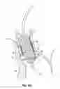 Fig. 35 - Devices, systems and methods to improve placement and prevent heart block with percutaneous aortic valve replacement