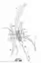 Fig. 45 - Devices, systems and methods to improve placement and prevent heart block with percutaneous aortic valve replacement