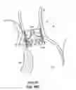 Fig. 46 - Devices, systems and methods to improve placement and prevent heart block with percutaneous aortic valve replacement