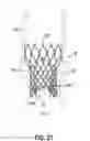 Fig. 49 - Devices, systems and methods to improve placement and prevent heart block with percutaneous aortic valve replacement