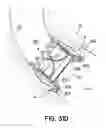 Fig. 64 - Devices, systems and methods to improve placement and prevent heart block with percutaneous aortic valve replacement