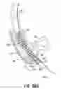 Fig. 69 - Devices, systems and methods to improve placement and prevent heart block with percutaneous aortic valve replacement