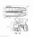 Fig. 03 - Minimally-invasive delivery systems