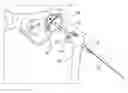 Fig. 01 - Prosthetic hip system
