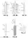 Fig. 03 - Tissue adjustment implant