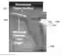 Fig. 01 - IMPLANT AND IMPLANTATION TOOL ADAPTED FOR OCCLUDING FALLOPIAN TUBES OF PLACENTAL MAMMALS